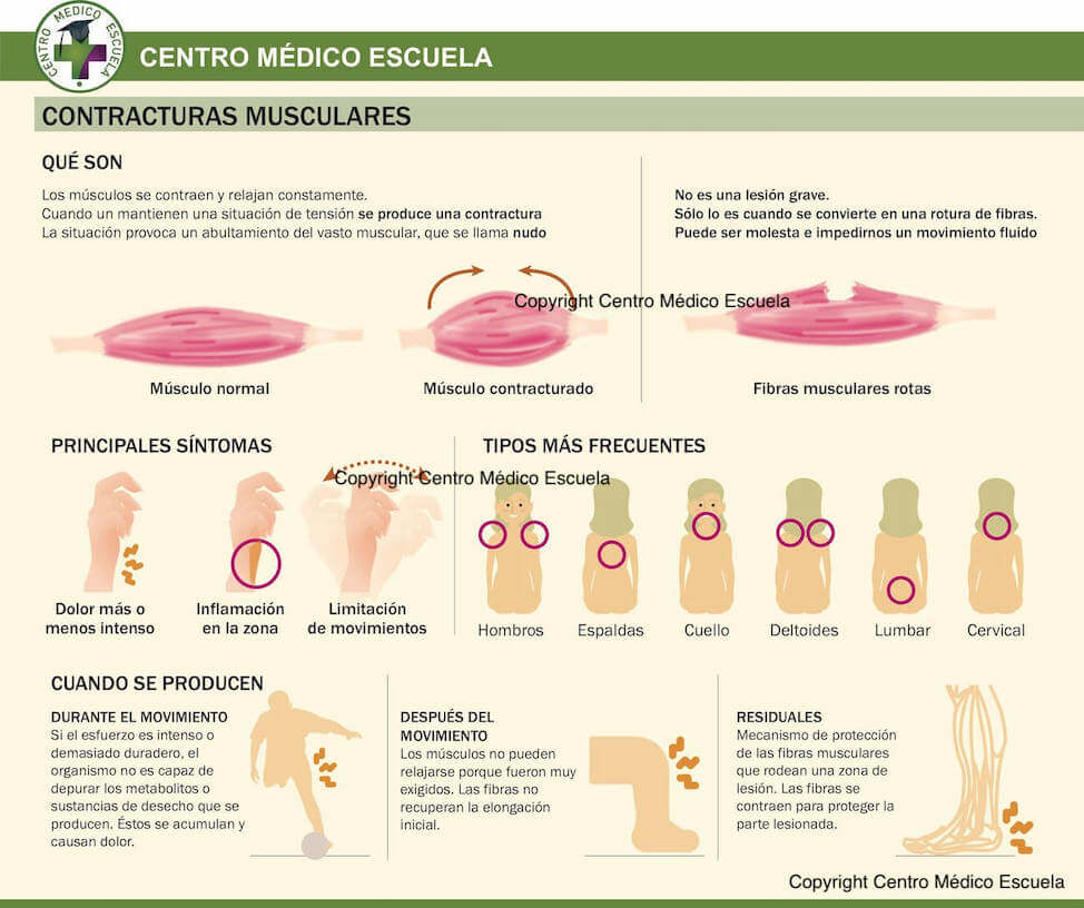 Qu Es Una Contractura Muscular Qu Es Una Contractura Muscular